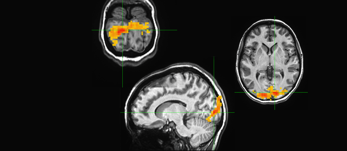 Neural activity in brain multiple brain scans