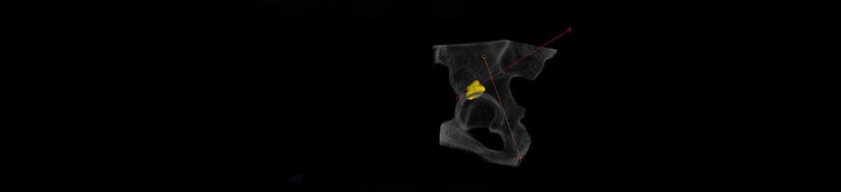3D image of pelvic bone