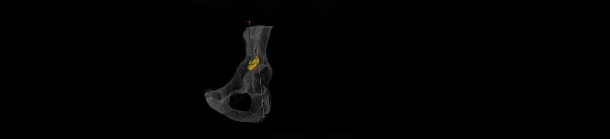 3D image of pelvic bone