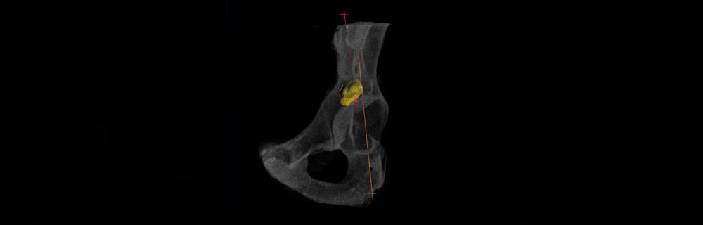 3D image of pelvic bone