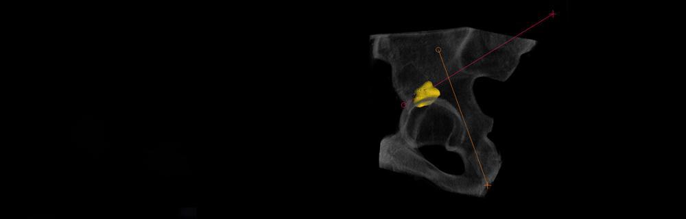 3D image of pelvic bone