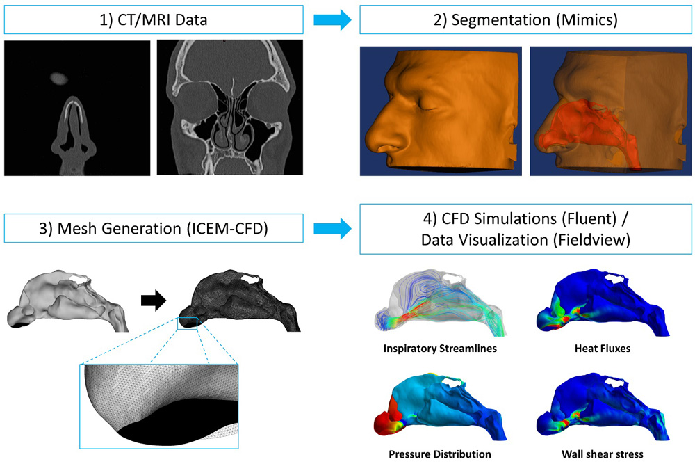 Diagram of Computational Fluid Dynamics illustrating  1) CT/MRI Data, 2) Segmentation 3) Mesh Generation (ICEM-CFD) and 4) CFD Simulations (Fluent) / Data Visualization (Fieldview)