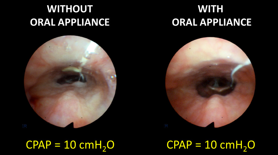 Images of oral cavity with and without appliance