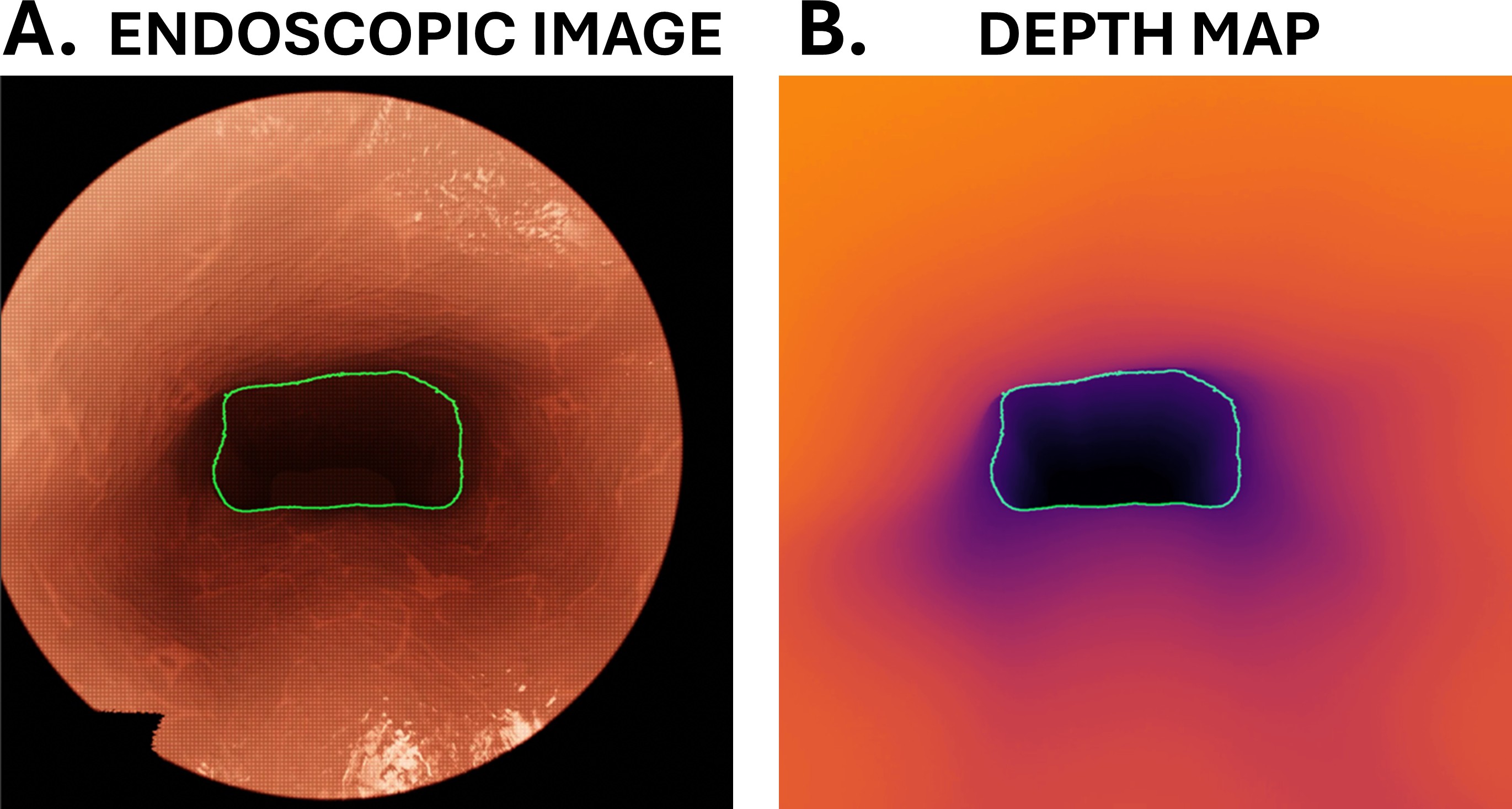 Quantitative endoscopy for airway evaluation