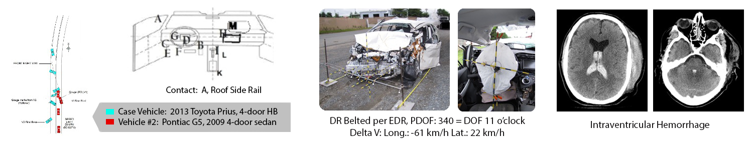 CIREN Case Sample - Brain Injury