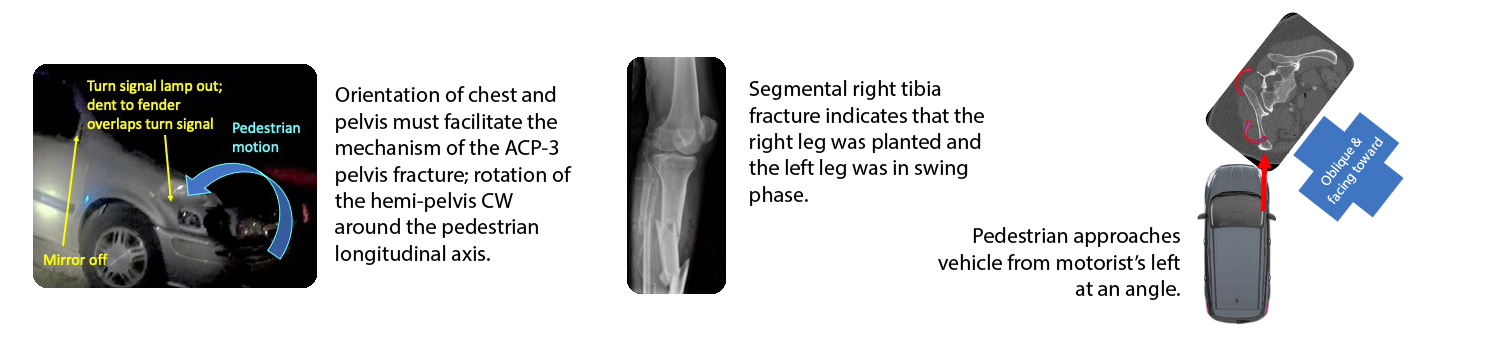 CIREN Case Sample - Pedestrian Crash