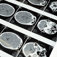 Multiple MRIs of human cranium