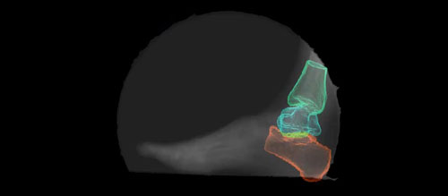 Foot and ankle x-ray captured in OREC's Motion Analysis Center at Shriners, Chicago.