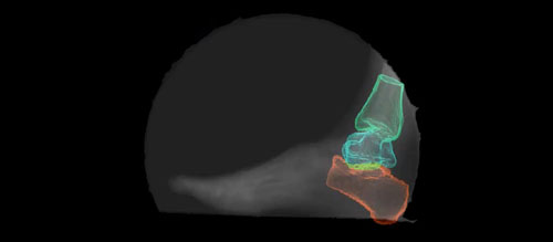 Xray of foot with color overlays describing components of motion analysis