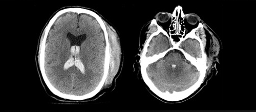 Image of Cranium after motor-vehicle accident