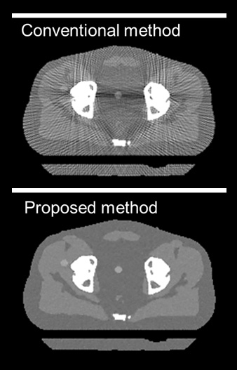 Samples of CT scan featuring conventional (top) vs. novel (bottom) metal artifact reduction technology