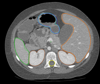 Sample of computer-generated organ identification in CT scan