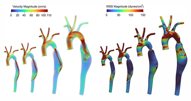 Coarctation of the Aorta visualized using Fluid-Structure Interaction Simulation