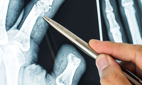 X-ray of hand