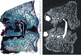 Stained Undecalcified histology image and corresponding microradiograph showing partial bone healing despite a cartilaginous pseudarthrosis within a titanium cervical spinal interbody fusion device (Trichrome Stain, mm scale in field).