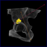 3D image of pelvic bone