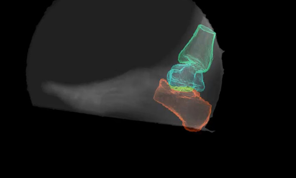 Imaging of foot with ankle bones  outlined with different colors.