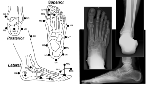 X-rays and illustration of segmental foot analysis