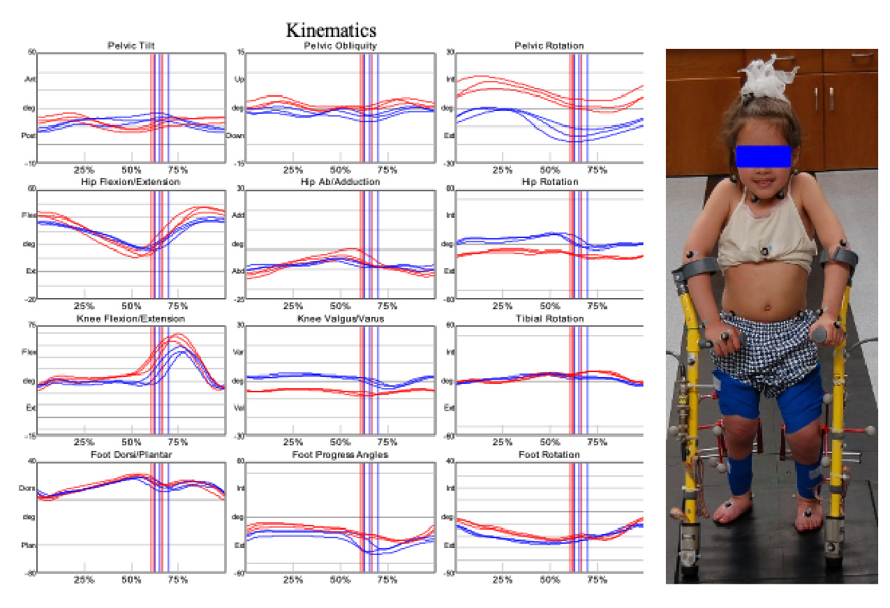 Images showing Tri-planar Kinematics: Sagittal, Coronal and Transverse Planes in a Population of Control Subjects illustrated by grey band and a Participant with Cerebral Palsy illustrated by red and blue bands.  Left image shows participant for Motion Analysis of Upper and Lower Extremities while using Lofstrand Crutches
