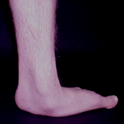Computer-generated representation of human clubfoot