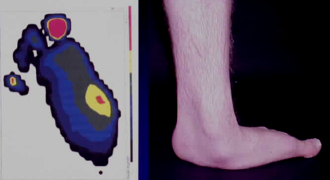 Plantar Pressure Pattern from a Participant with Clubfoot during Normal Ambulation and Standing Presentation of Participant with Clubfoot.
